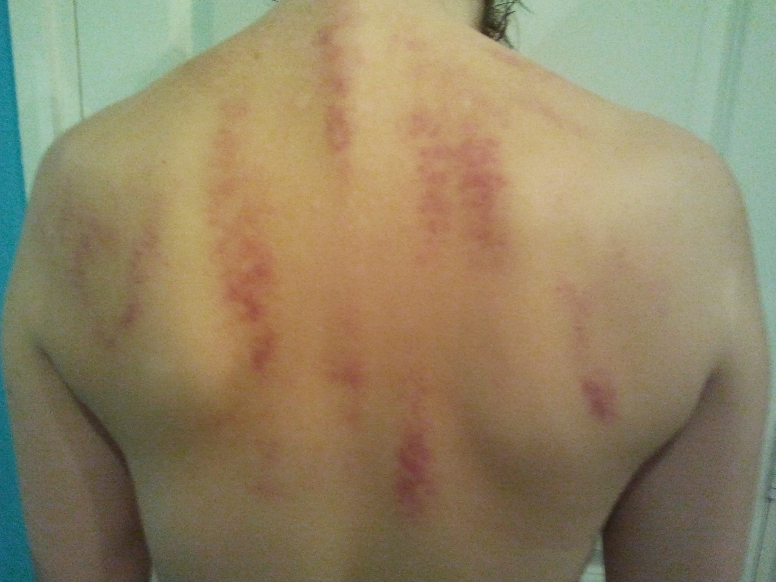 Mijn rug na de eerste Guasha behandeling